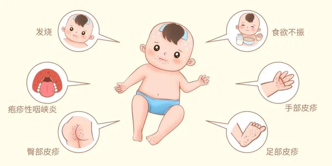 手足口病临床表现.jpg